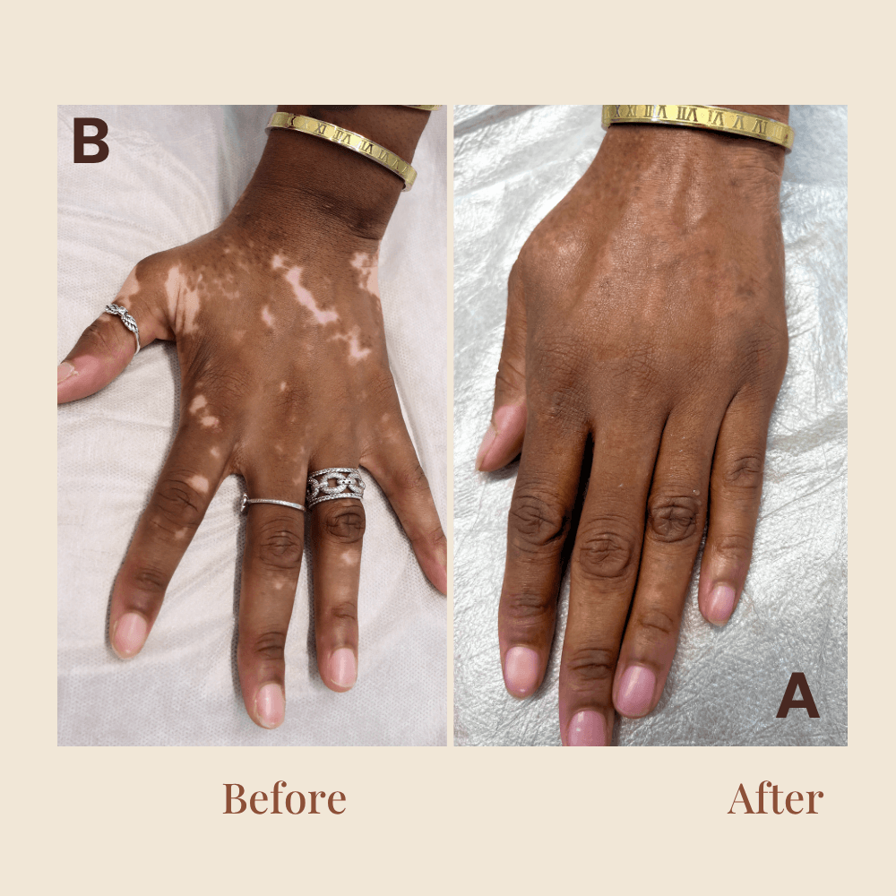 Scar Camouflage — Surgical