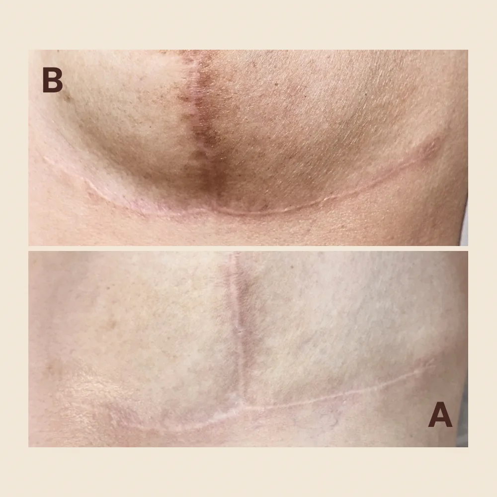 Mastectomy scar — pigment softened and blended