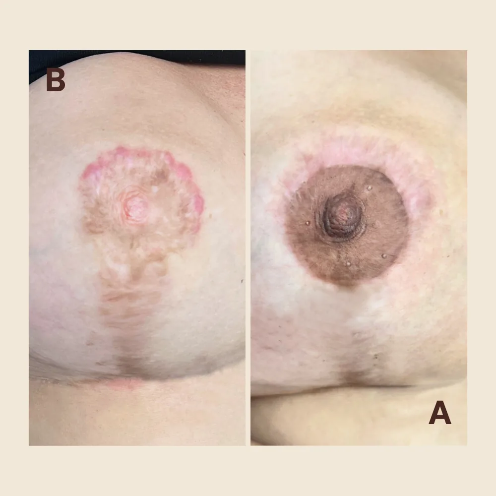 3D Areola & Nipple Tattoo — Breast