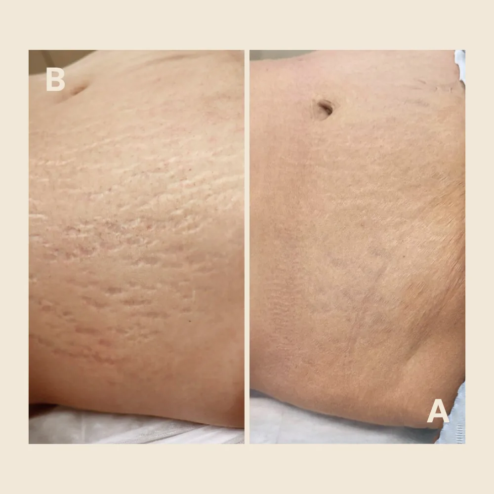 Stretch Mark Camouflage Aftercare: Understanding the Healing Process