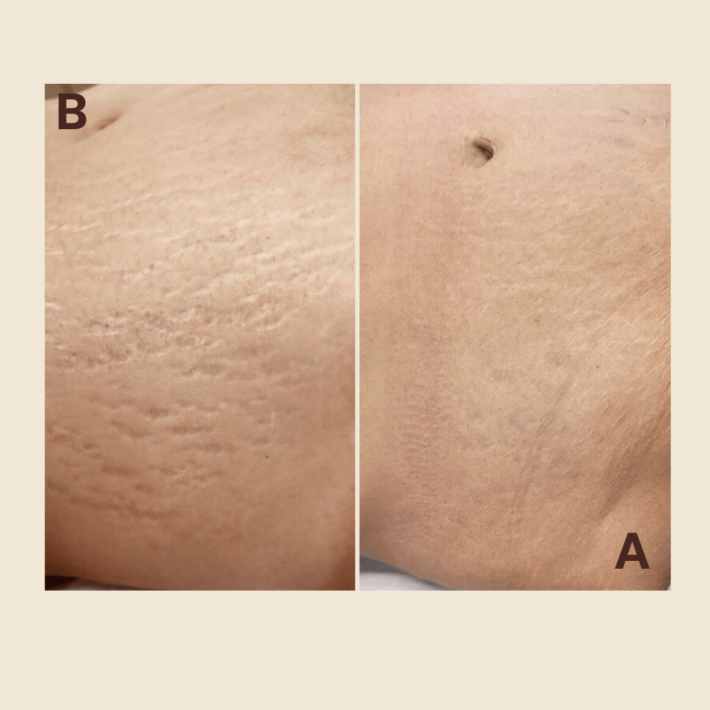 Abdominal stretch marks — pigment blended into skin tone