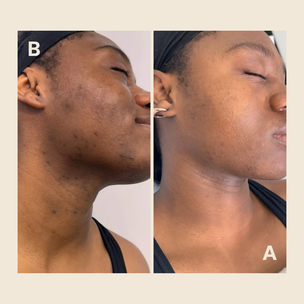 Facial marks on cheek and neck — tone evened