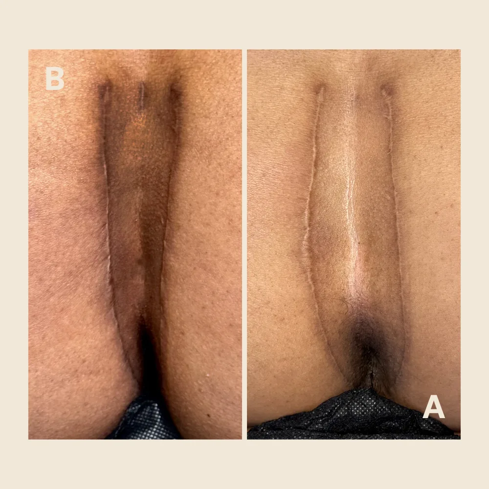 Biopolymer removal scar — texture and pigment blended