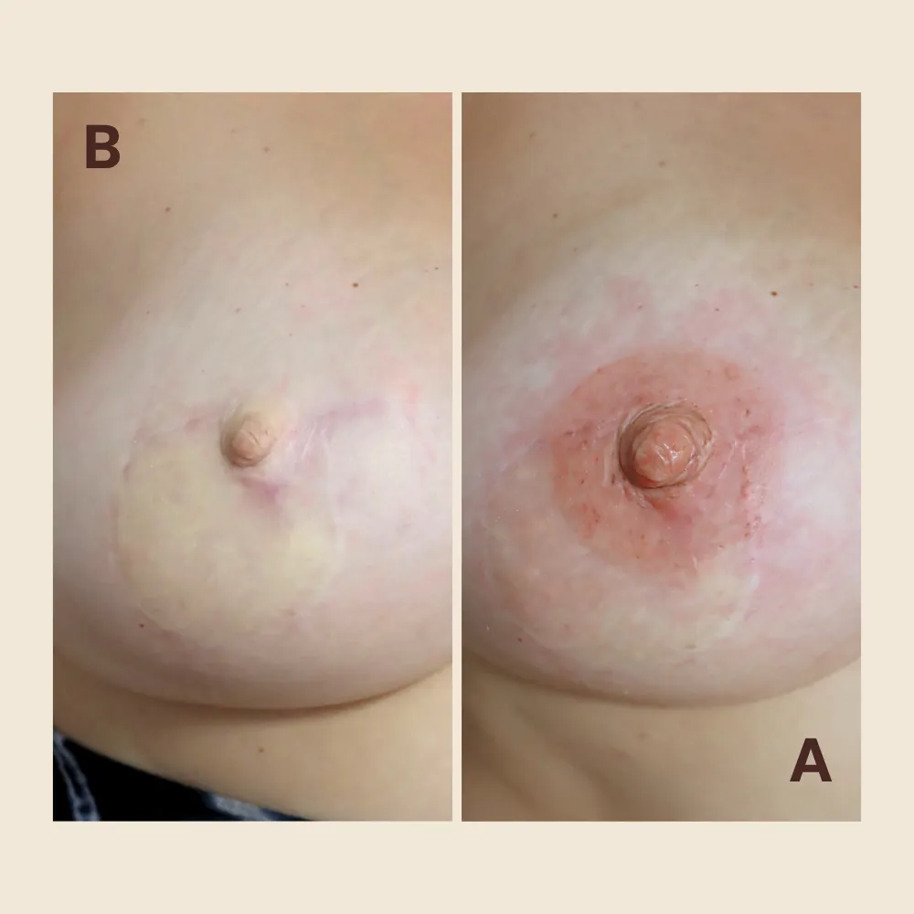 Nipple Reconstruction vs. Nipple Tattoo: Which Option Is Right for You?