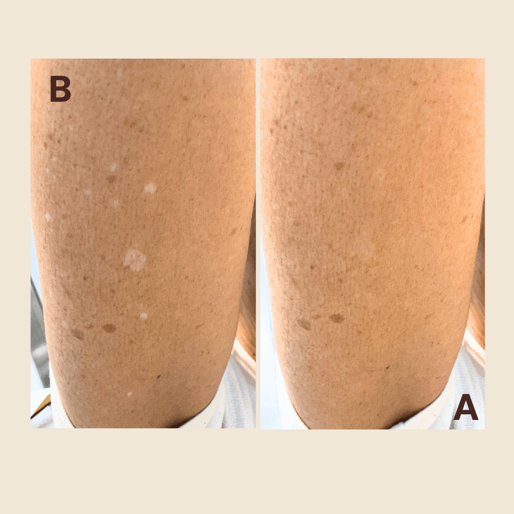 Leg hypopigmented marks — blended seamlessly
