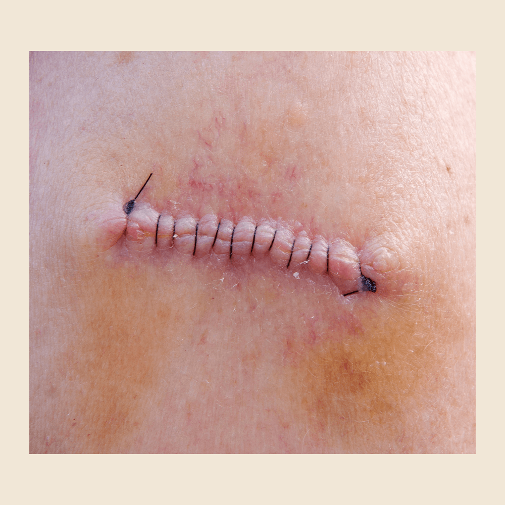 Pre- & Post-Op Scar Management — by Natalia Mejia, NYC