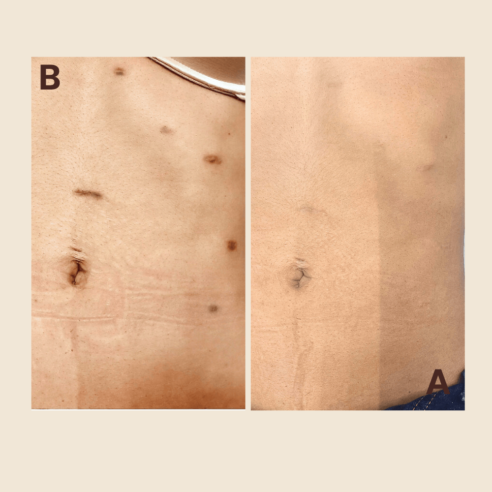 Abdominal scar — pigment camouflaged