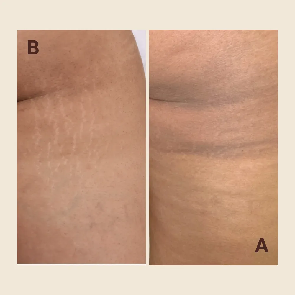 Before and after stretch mark camouflage on the upper thigh: pale, indented stretch marks below the buttock crease before treatment, then blended to match the surrounding skin tone