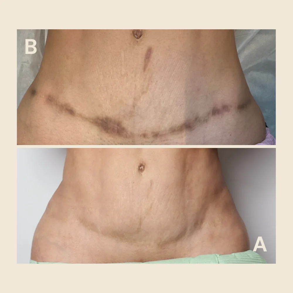 Scar Regeneration & Camouflage — Tummy Tuck
