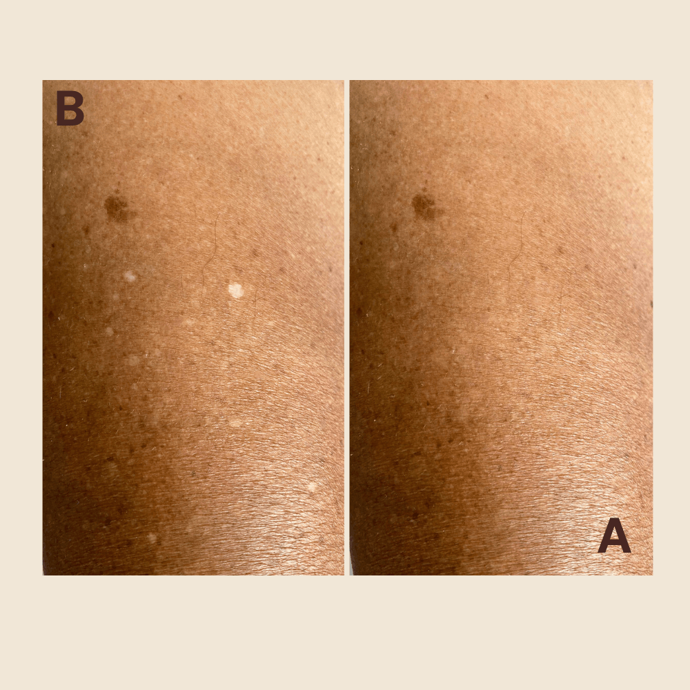 Shoulder hypopigmented spots — evened out