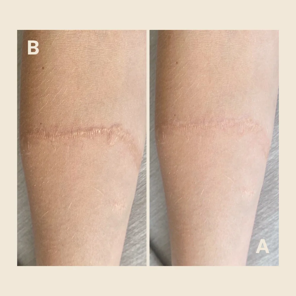 Forearm scar — texture and pigment evened out