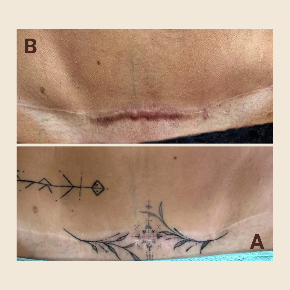 Scar Regeneration & Camouflage — Abdomen
