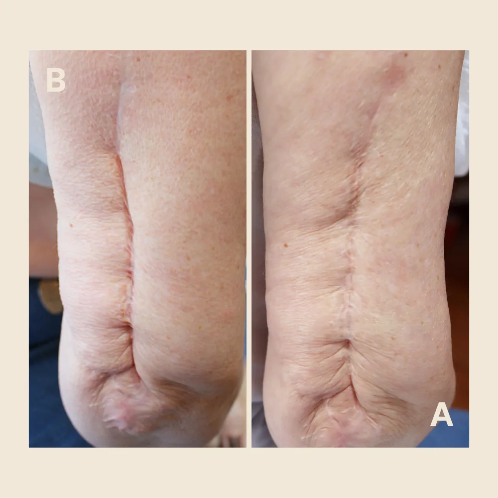 Arm scar — camouflaged and blended into skin tone