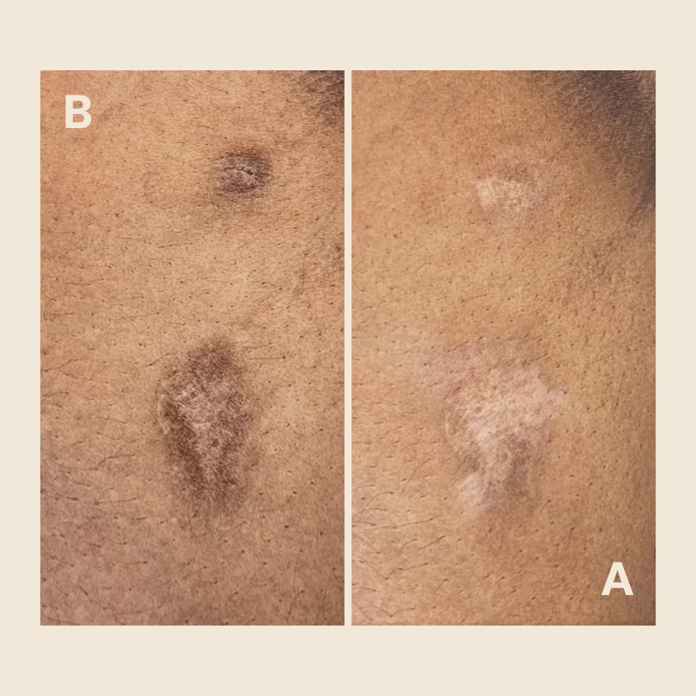 Burn scars on chest — pigment matched to skin tone