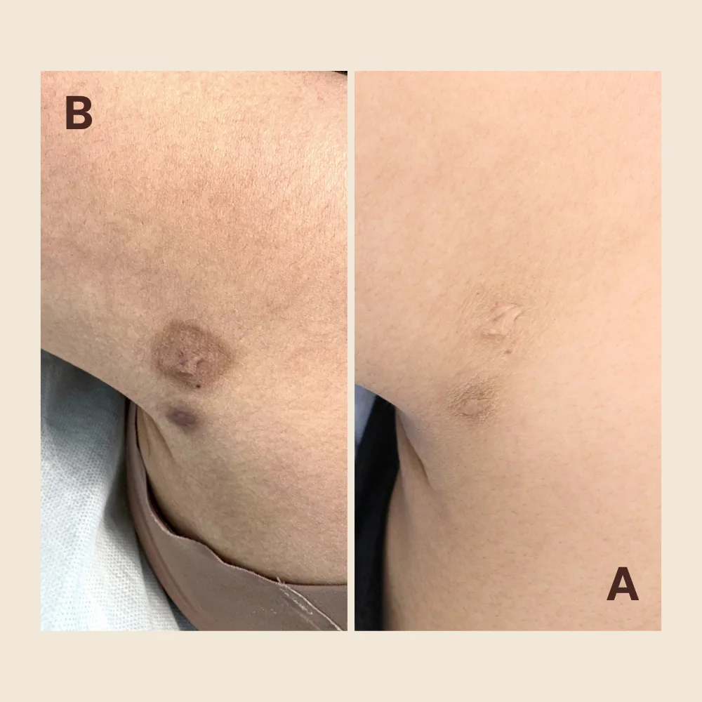 Previous areola ink — lightened and softened