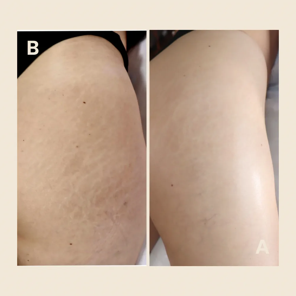 Thigh stretch marks — fully blended