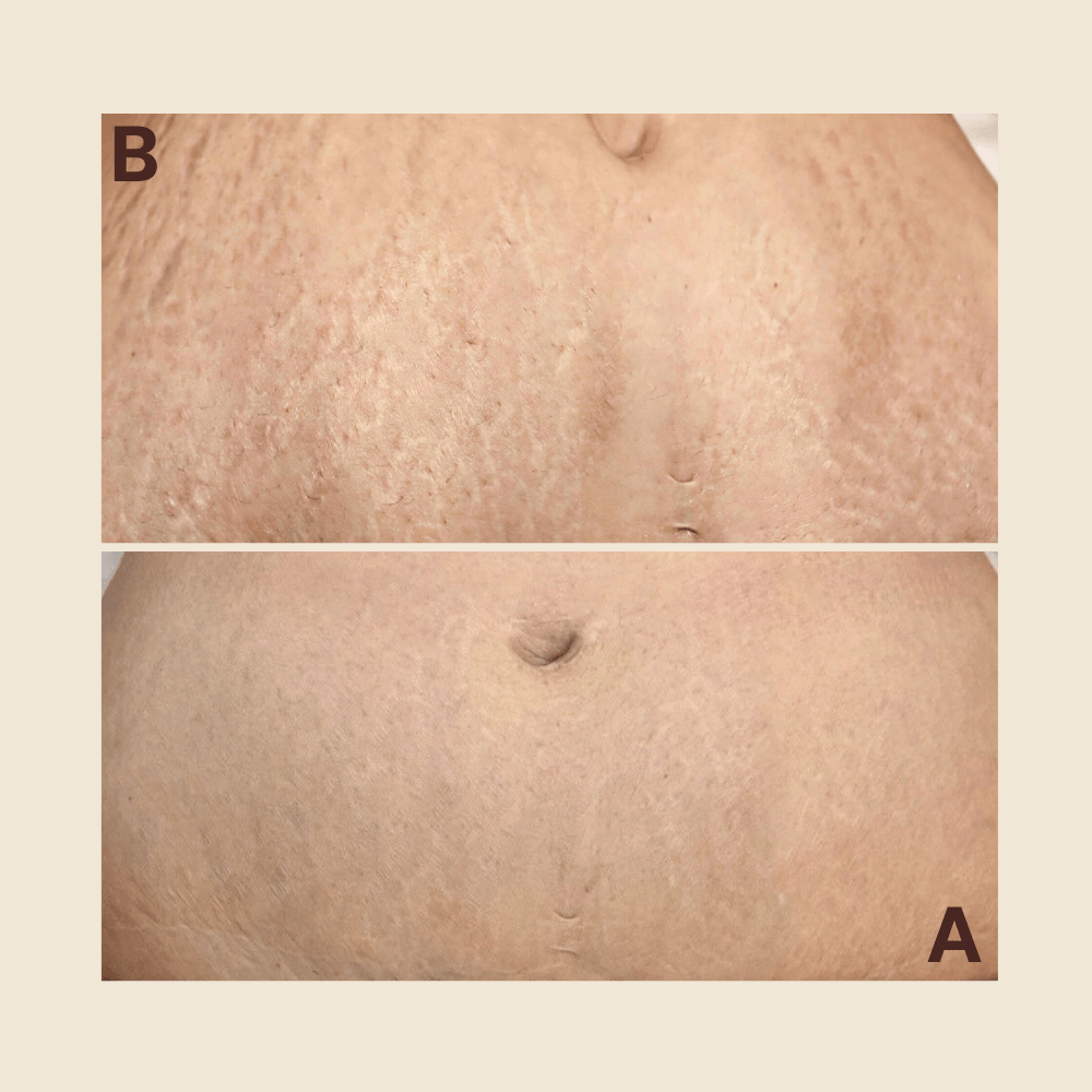Stretch Mark Regeneration — Abdomen