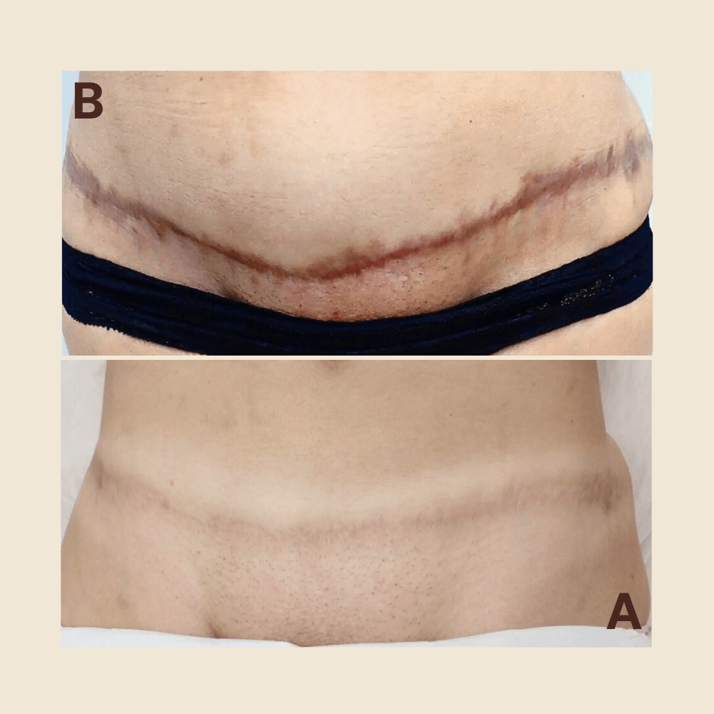 C-section scar — softened and evened out