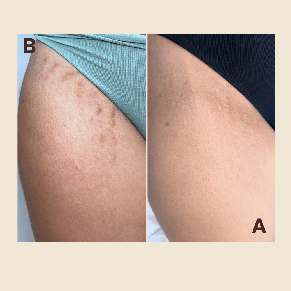 Thigh stretch marks — color matched and softened