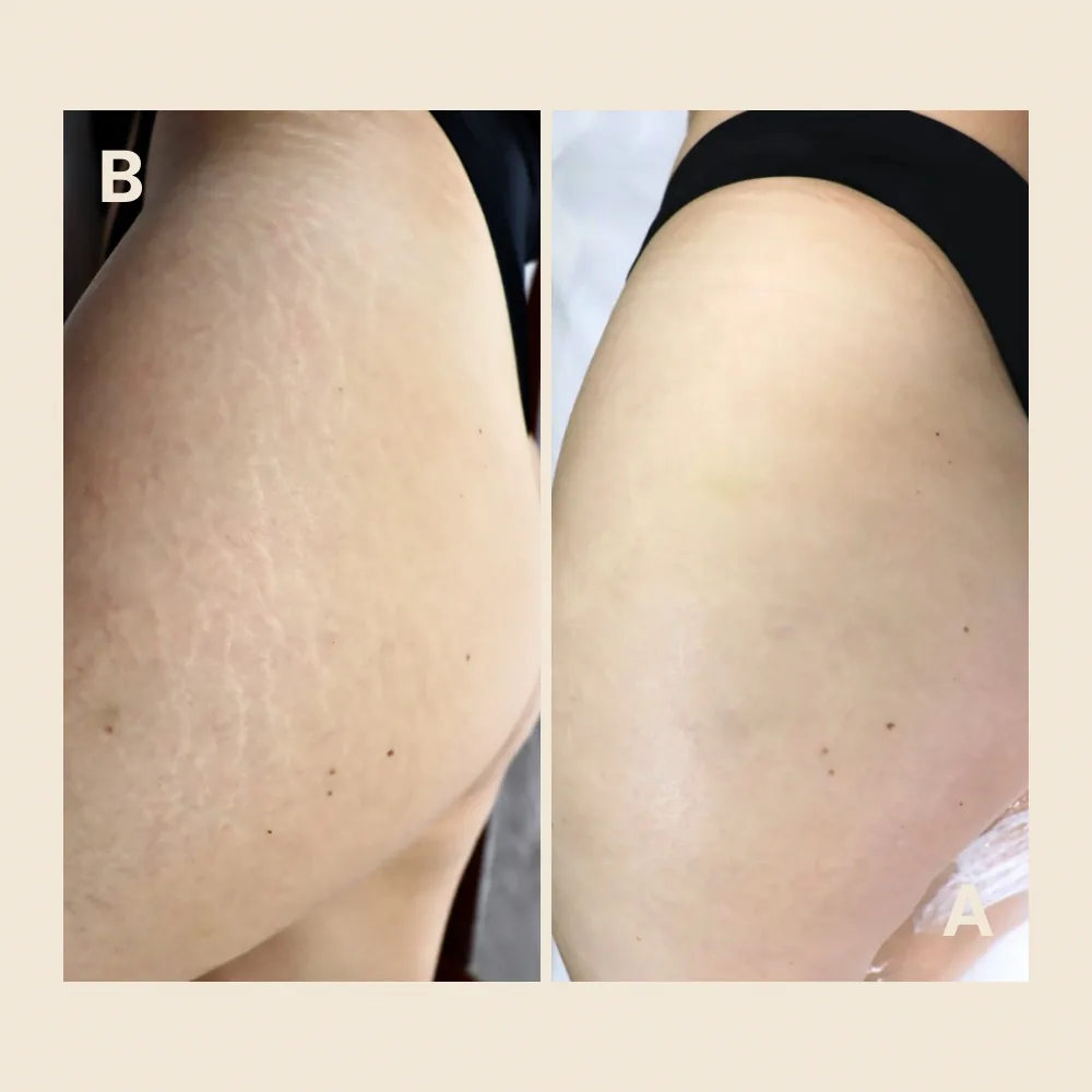 Outer thigh stretch marks — texture and tone evened out