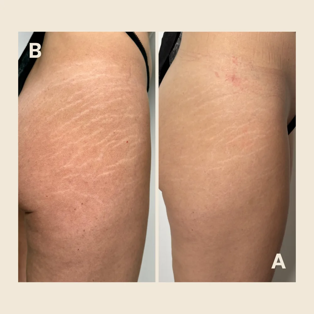 Thigh and hip stretch marks — pigment blended into skin tone