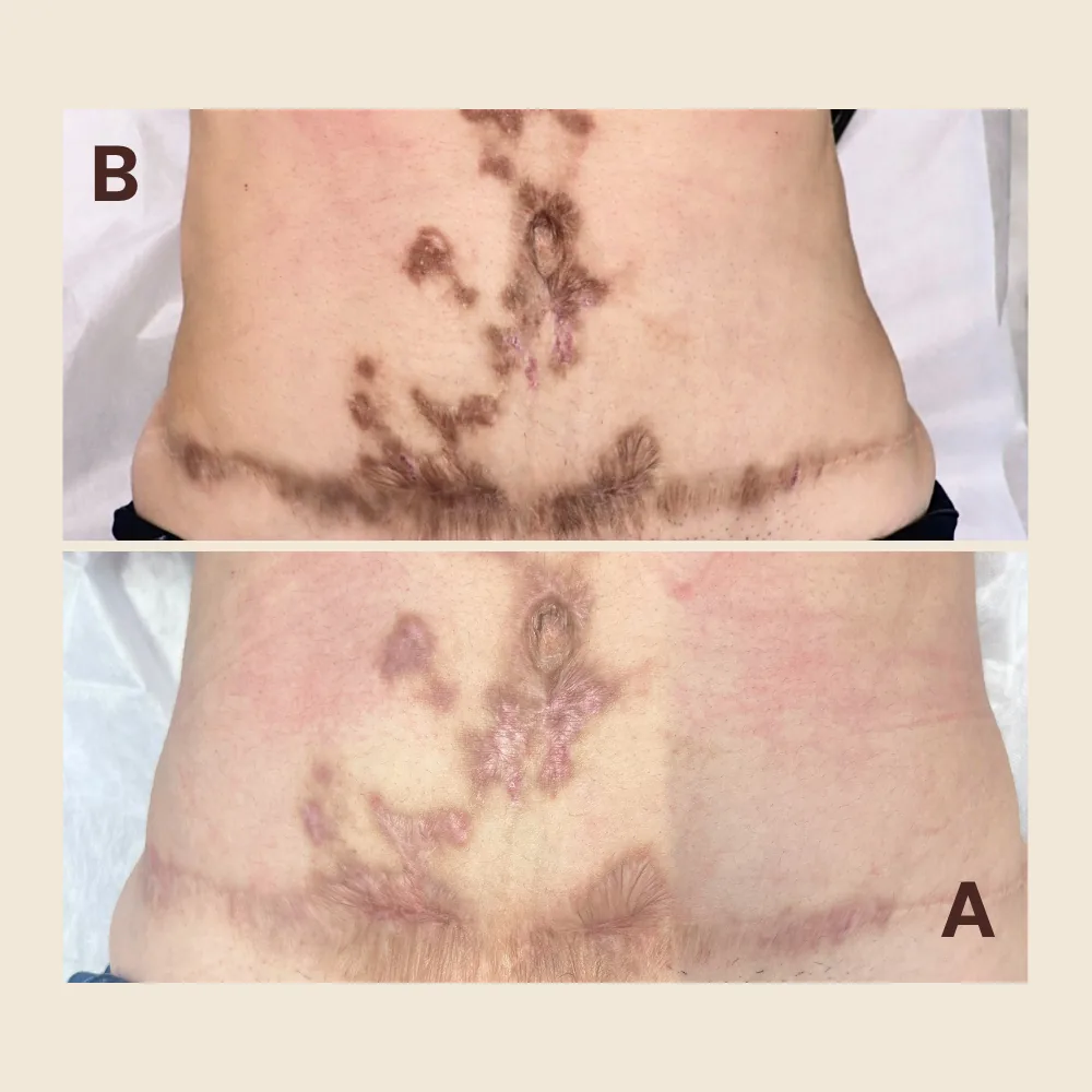 Tummy tuck scar with dark patches — tone rebalanced