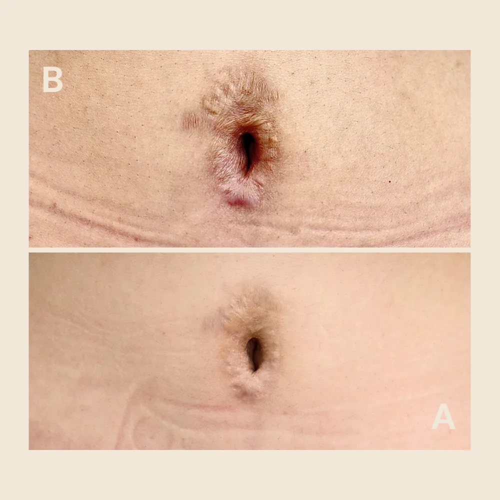 Belly button scar — texture softened and tone blended