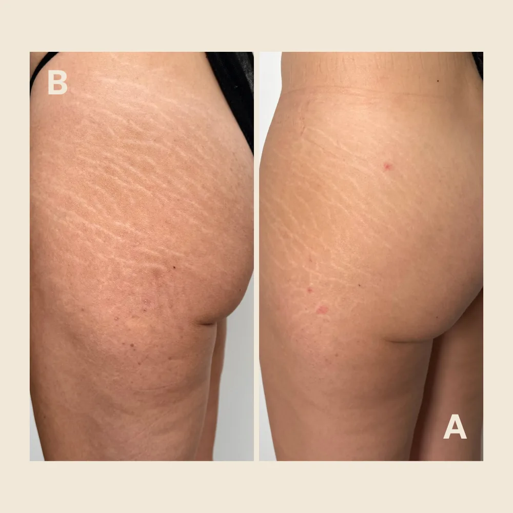Glute stretch marks — color matched and softened