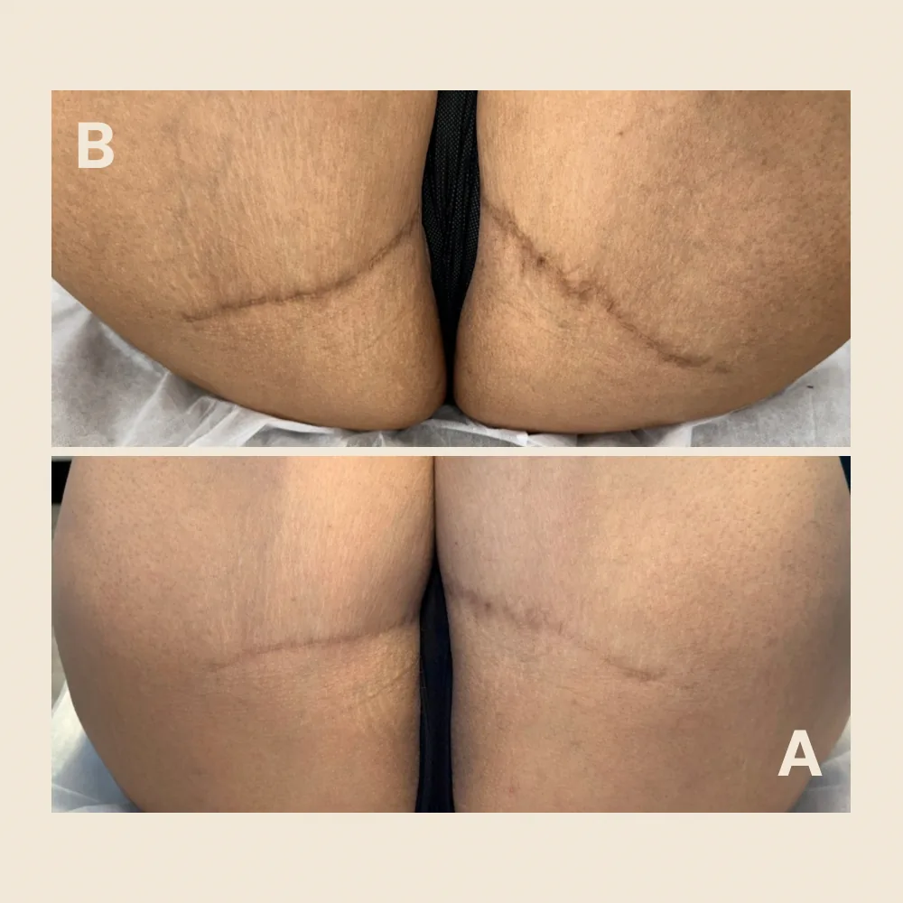 Leg lift scars — blended on both sides