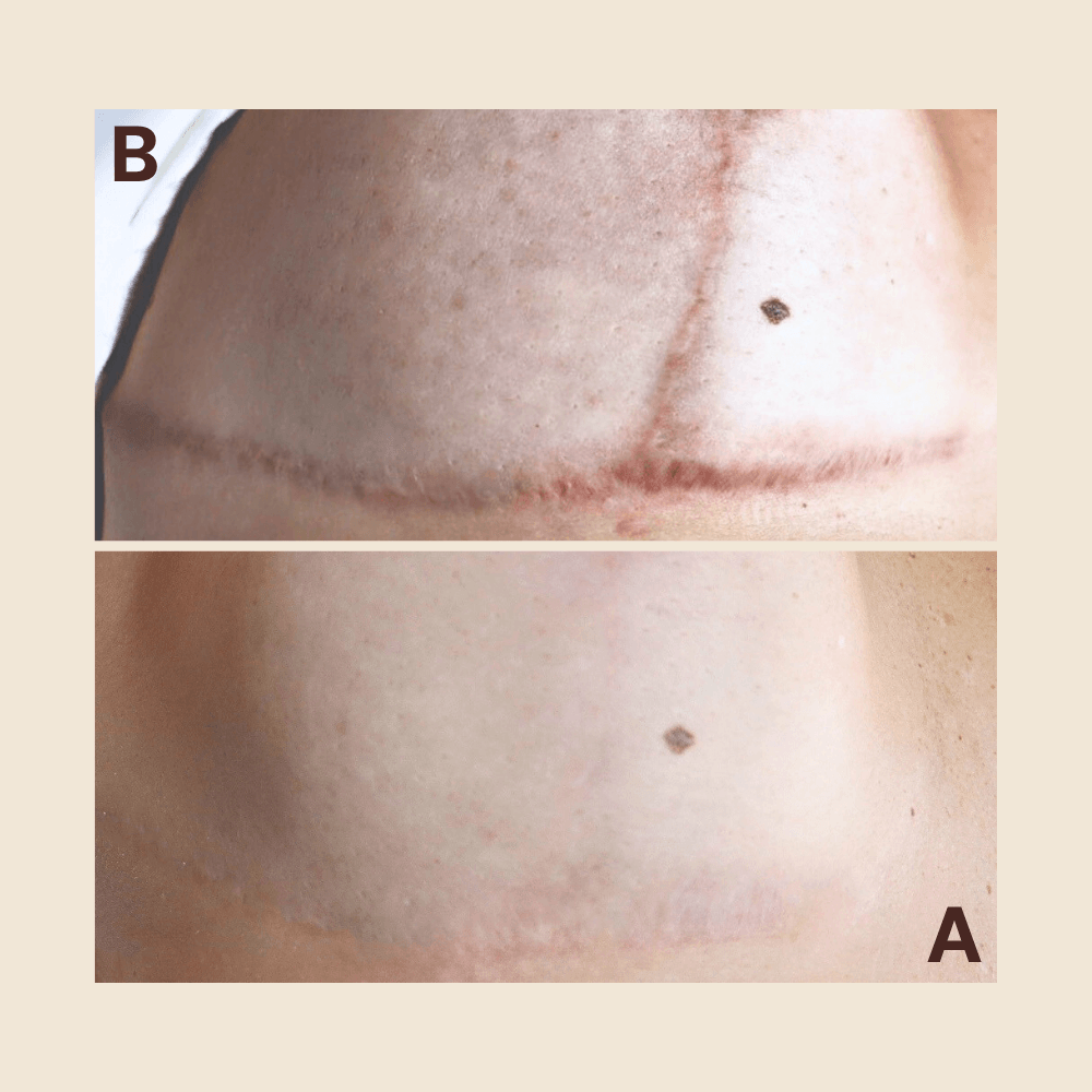 Post-surgical scar — texture and color refined