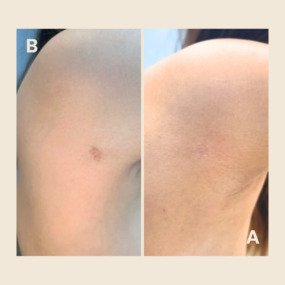 Lipo scar on the flank — softened