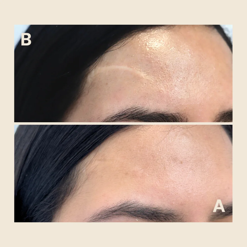 Hypopigmented forehead scar — tone matched to the skin