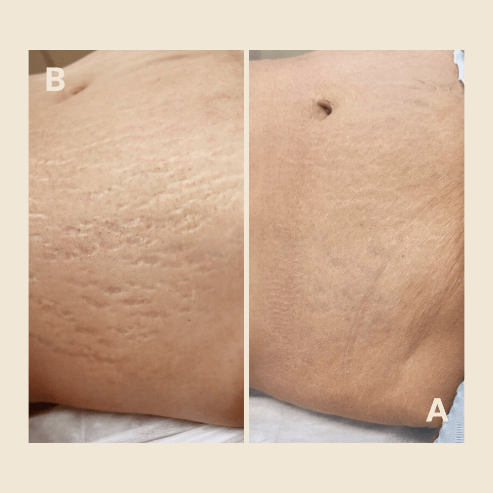 Stretch Mark Regeneration — by Natalia Mejia, NYC