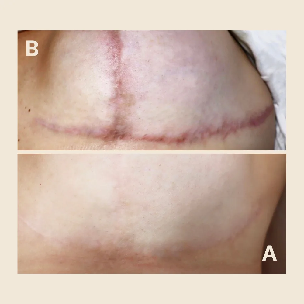 Scar Regeneration & Camouflage — Breast