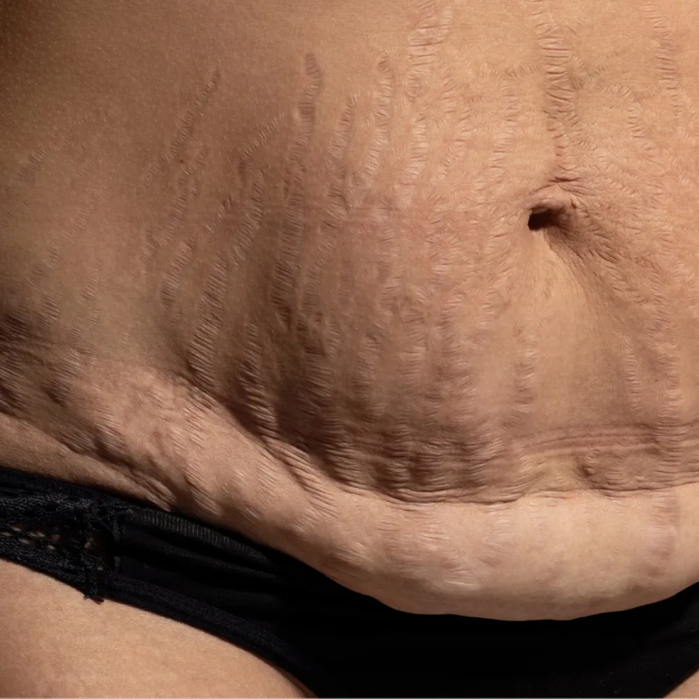 Close-up of excess, sagging skin and stretch marks on the abdomen after major weight loss, before body contouring surgery