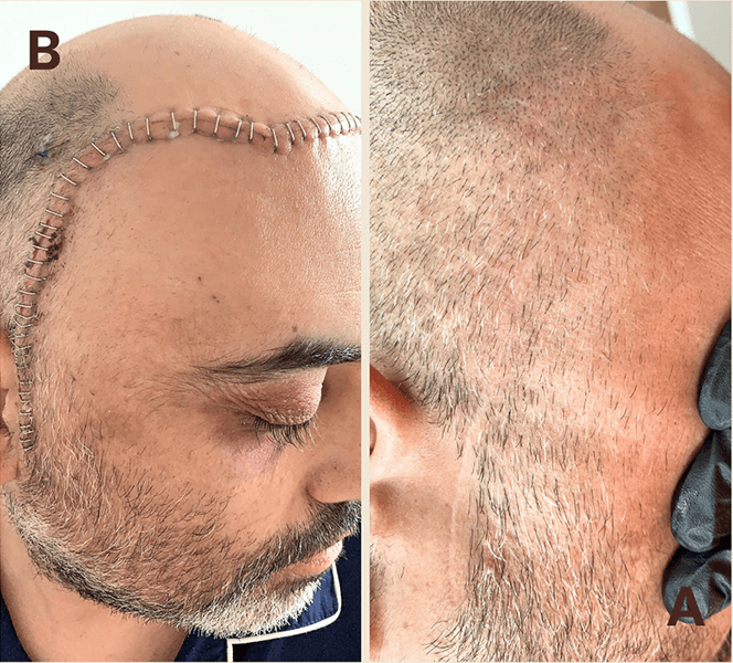 Scar Revision NYC before and after result