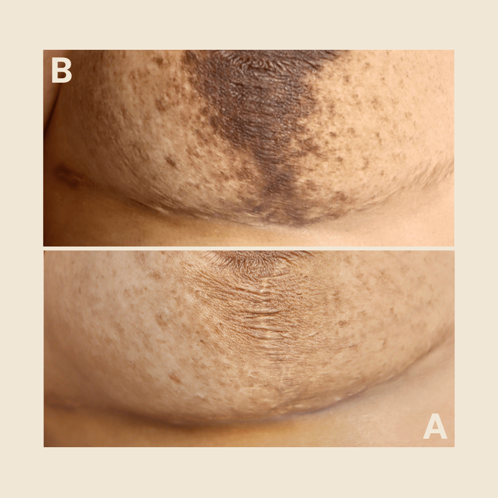 Abdominal scar — hyperpigmentation reduced