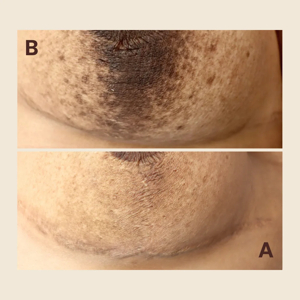 Scar Regeneration & Camouflage — Breast