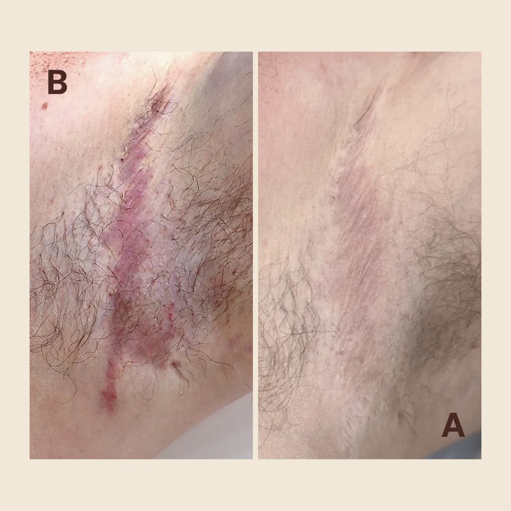 Axillary scar — texture and tone evened out