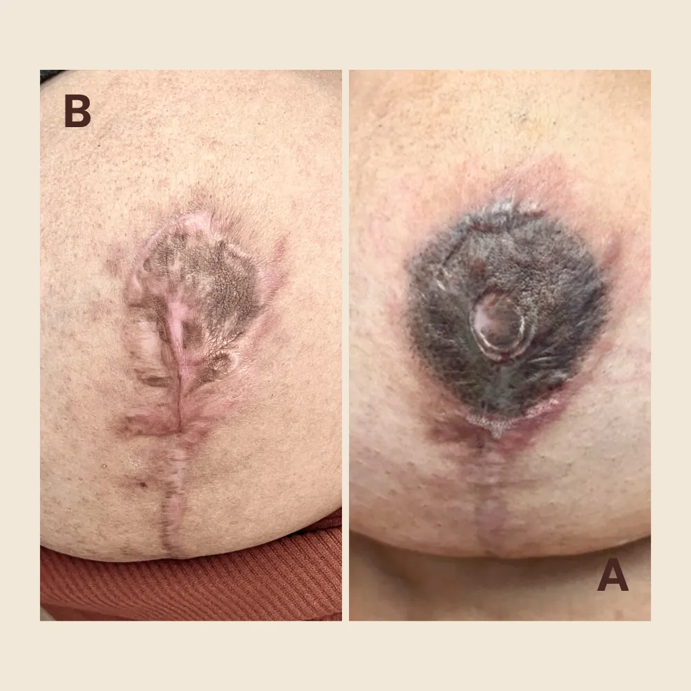Areola Necrosis After Surgery: Understanding Your Recovery Options