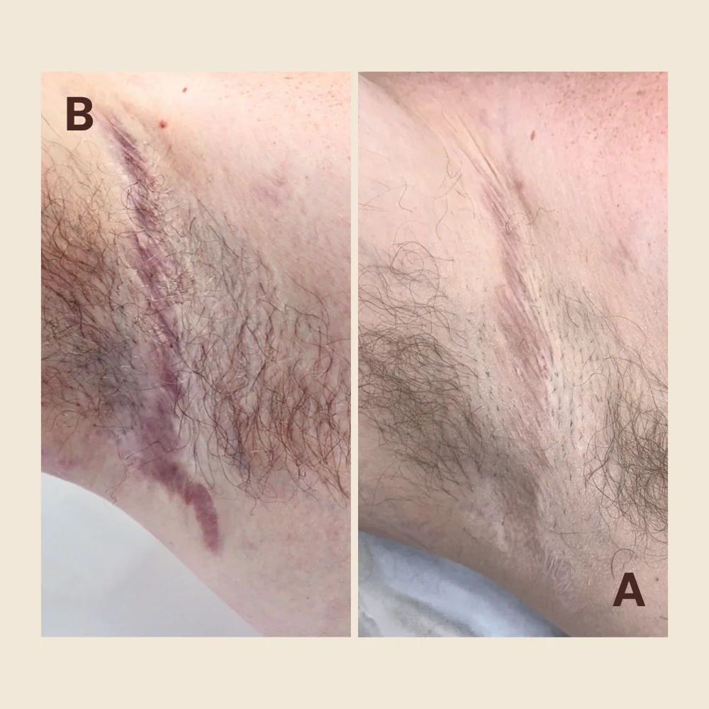 Underarm scar — pigment softened and blended