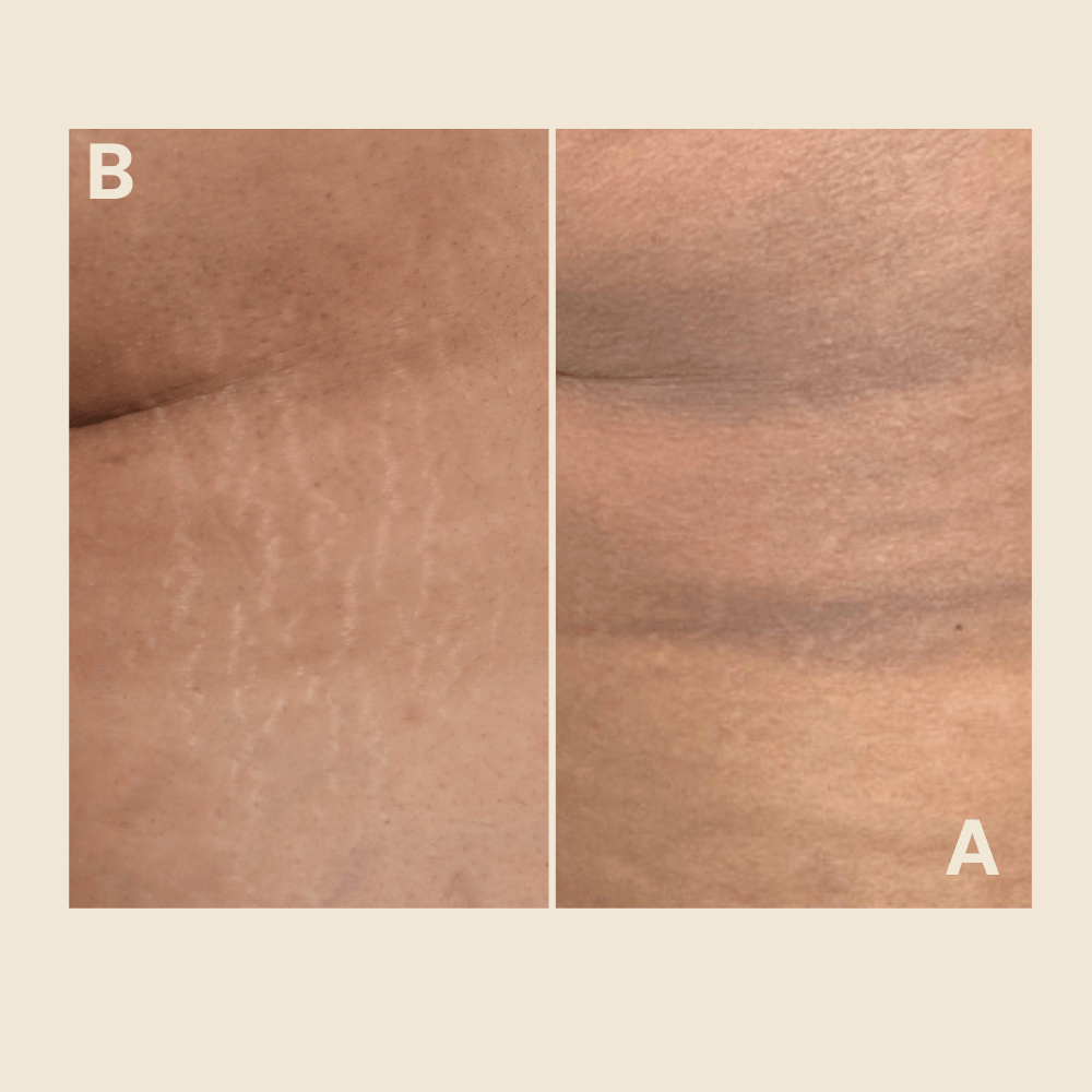 Stretch Mark Regeneration — Hips