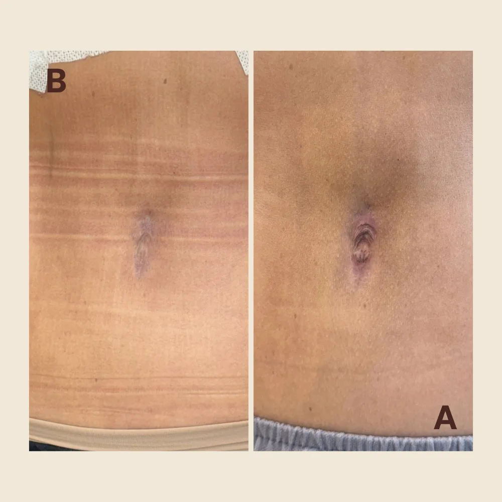 Abdominal scar around the navel — camouflaged