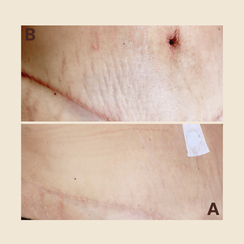 Lower abdomen near c-section — stretch marks camouflaged