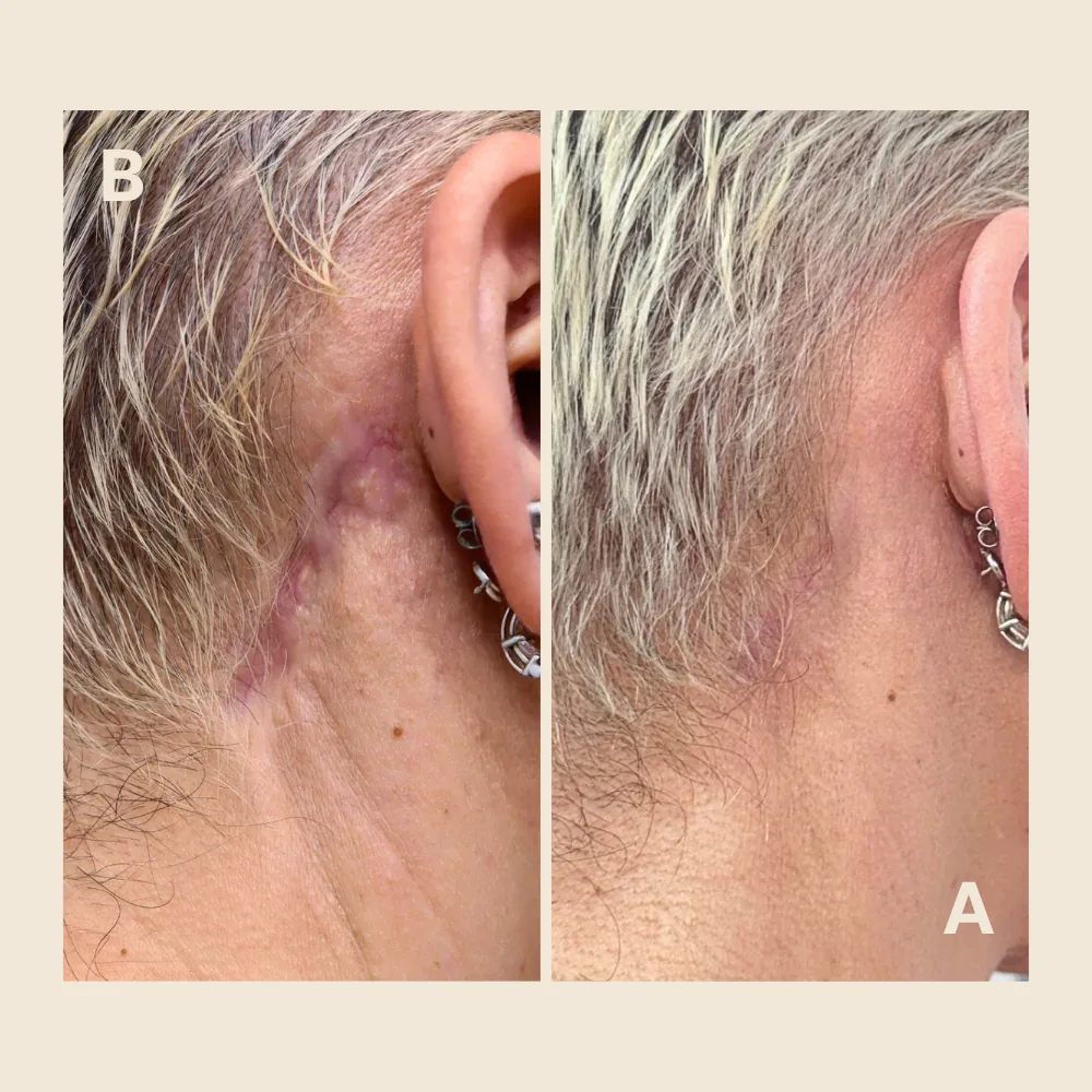 Scar Healing Stages and Timeline: What Happens From Week 1 to Month 18