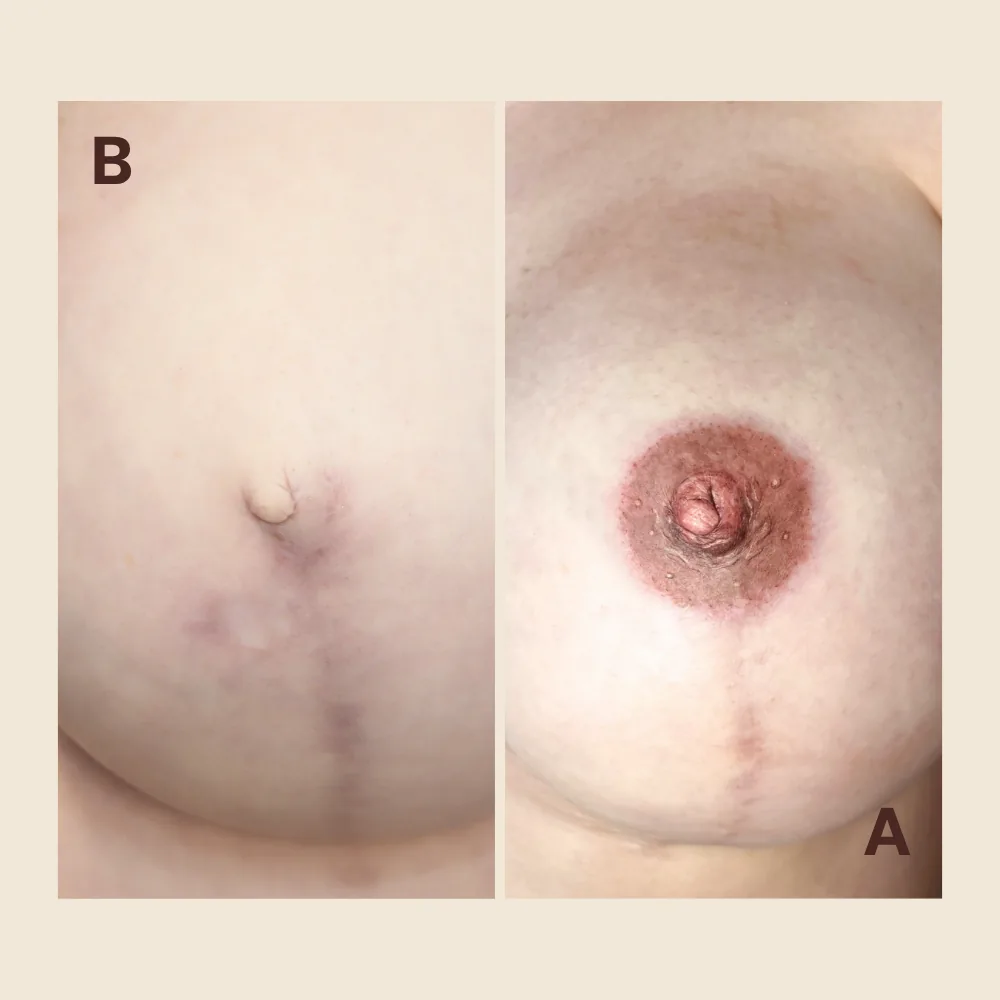 3D Areola & Nipple Tattoo — Breast
