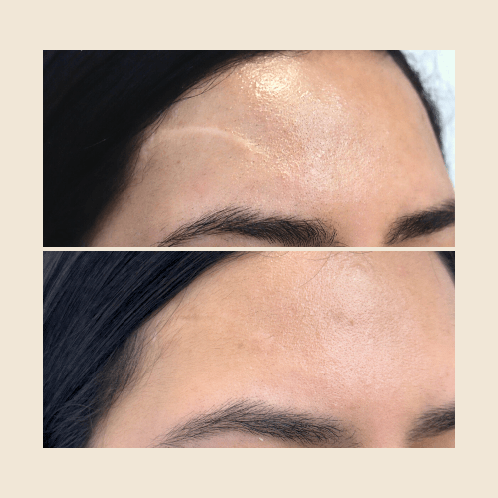 Forehead scar — smoothed and blended