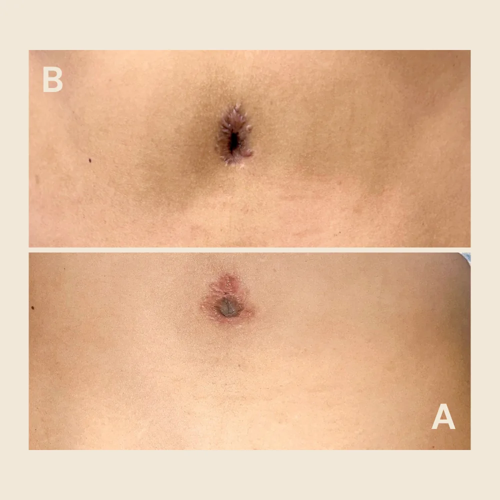 Navel scar — pigment evened out after surgery