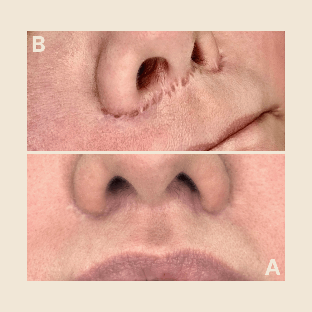 Nasal scar — texture refined