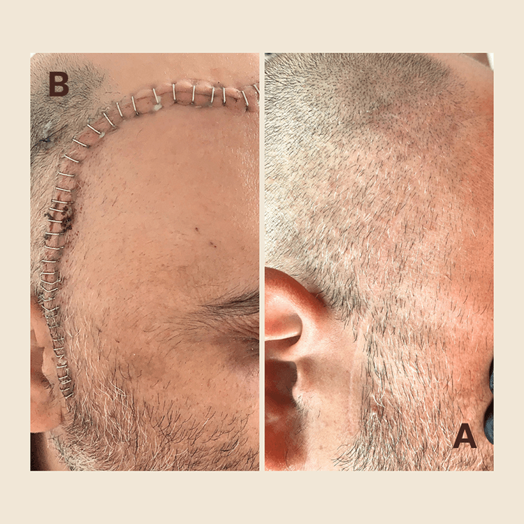 Pre- & Post-Op Scar Management — by Natalia Mejia, NYC